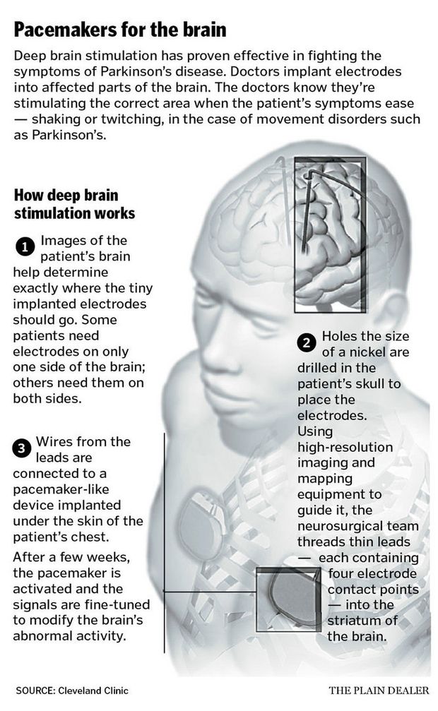 How deep brain stimulation is used to treat Parkinson’s ...