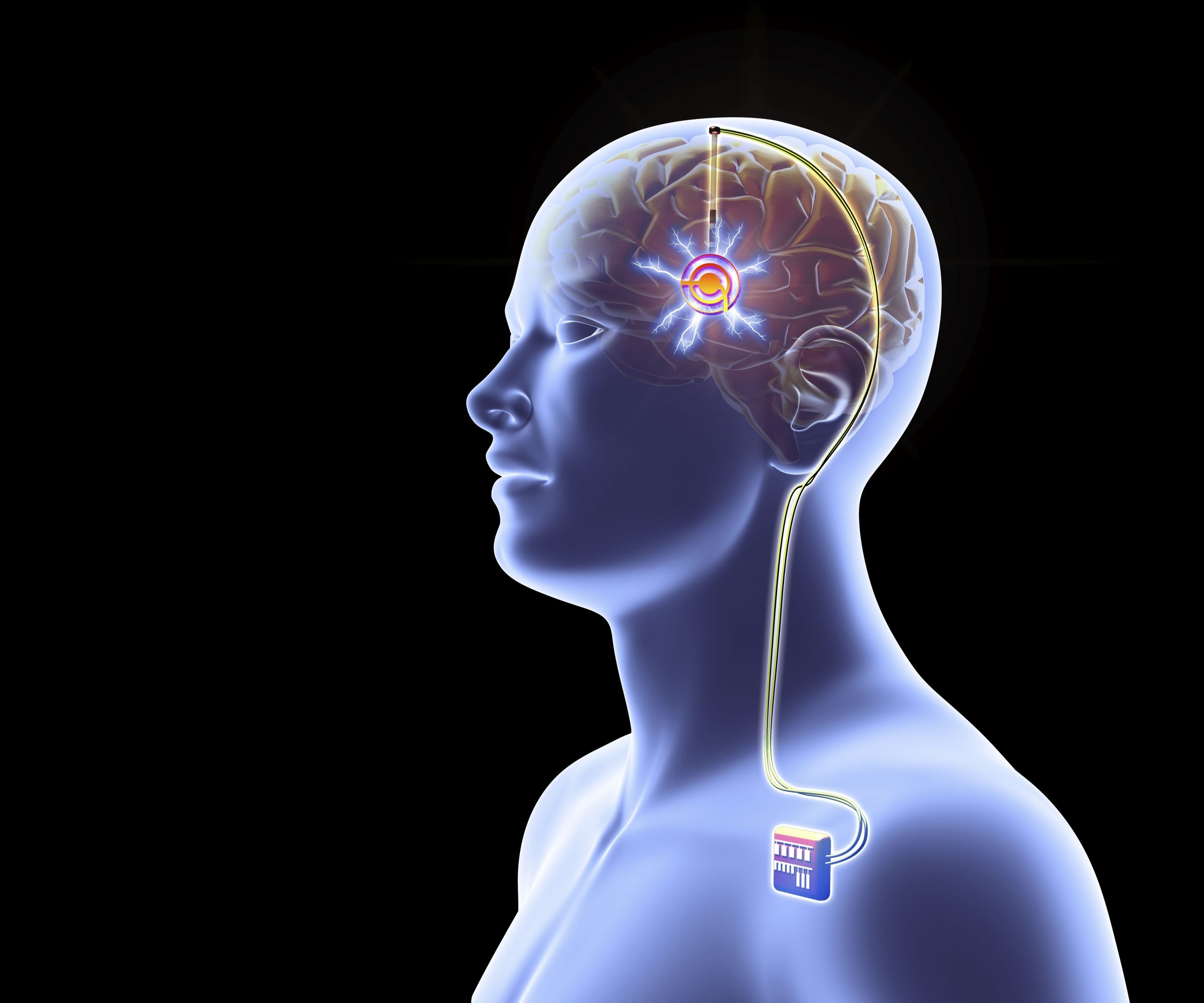 Is Deep Brain Stimulation Effective for Alzheimer