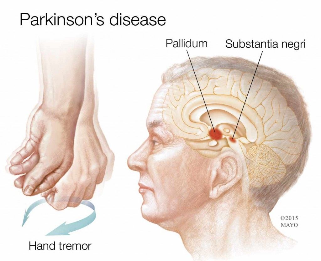 medical illustration showing hand tremor due to Parkinson ...