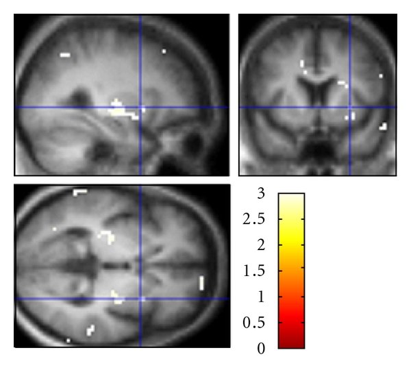 A Perfusion MRI Study of Emotional Valence and Arousal in Parkinsons ...