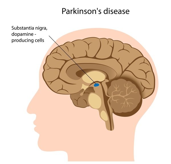 Advancements in a Cure for Parkinsonâs Disease