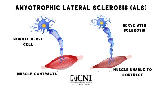 ALS disease leads to motor neurons that go from the brain ...