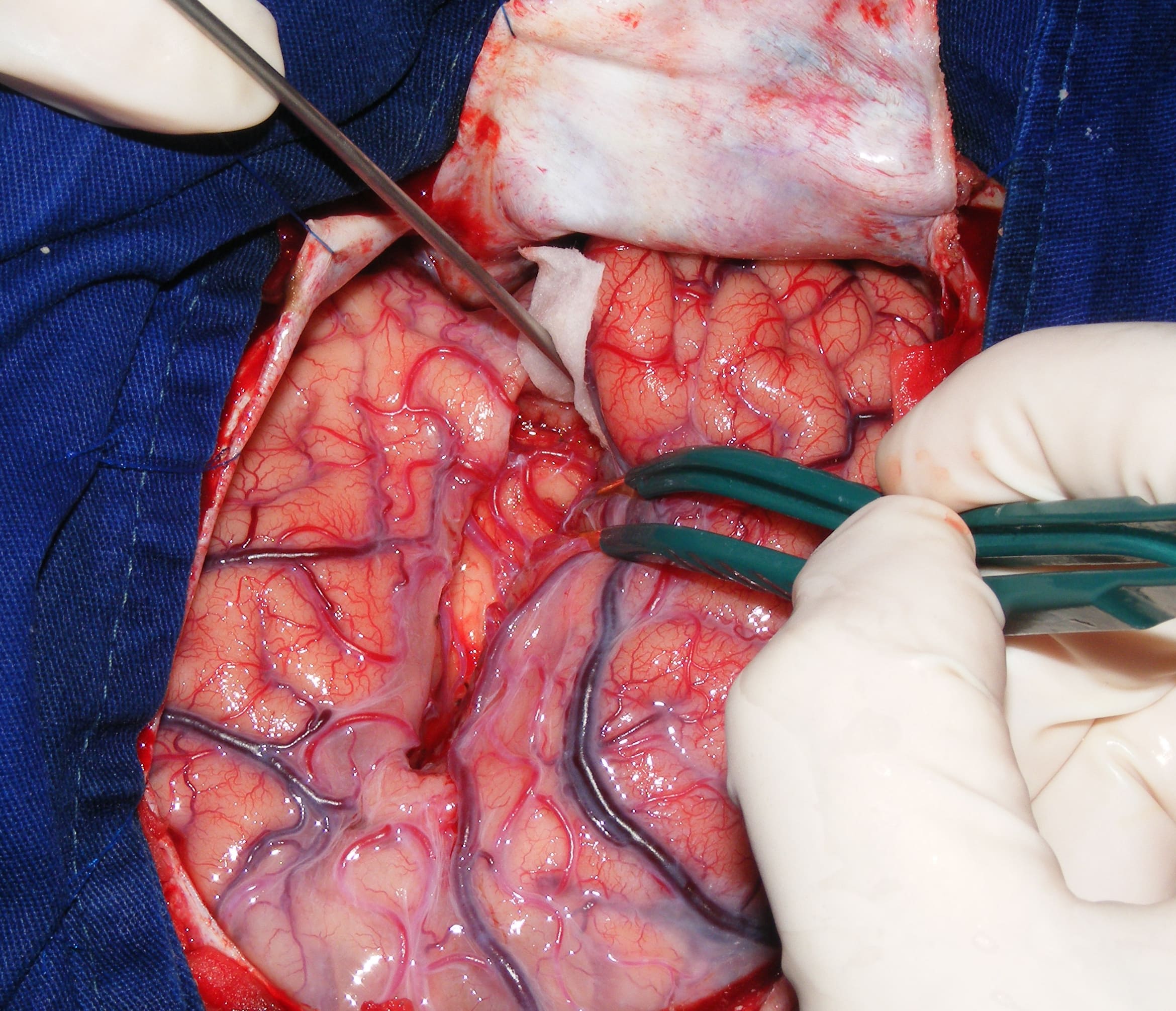 Autologous Brain Cell Transplant for Parkinson Disease