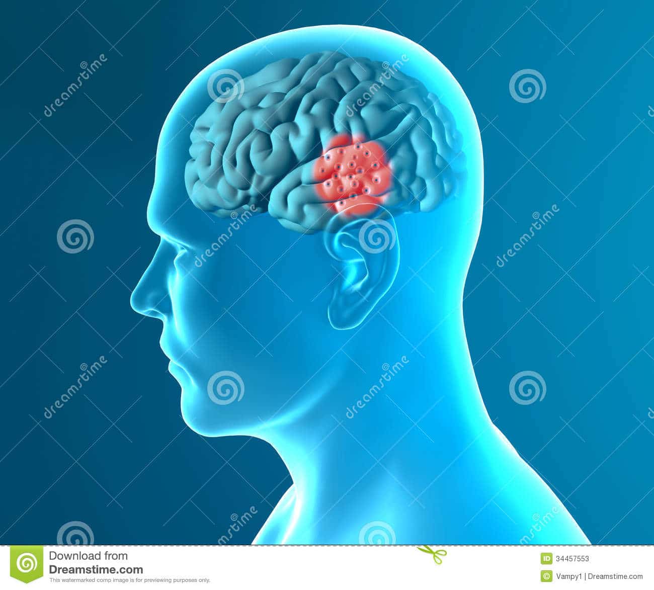 Brain Degenerative Diseases, Parkinson, Synapses, Neurons, Alzheimer`s ...