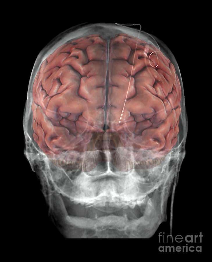 Brain Implants For Parkinson