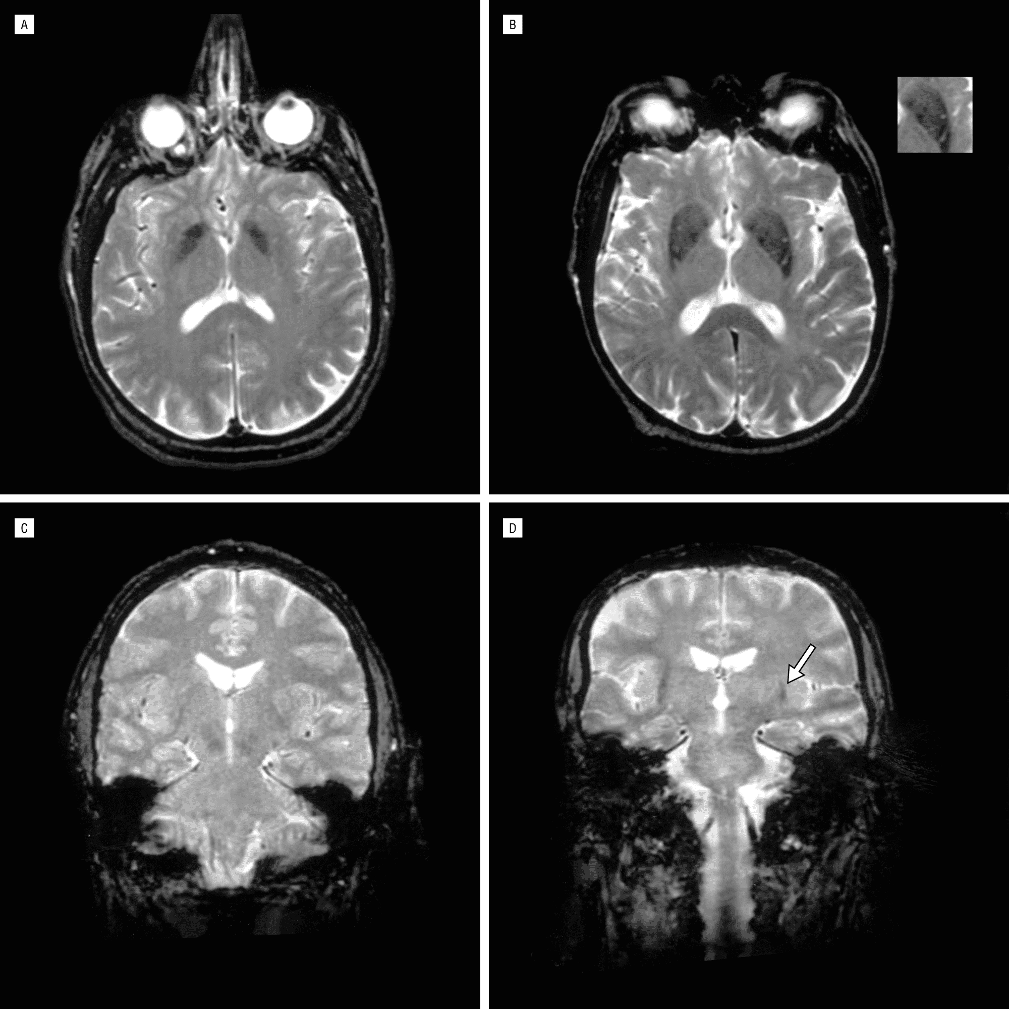 Brain Magnetic Resonance Imaging in Multiple