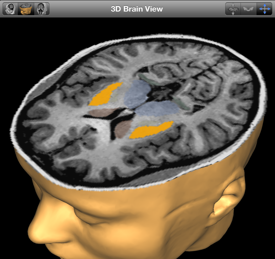 Brain Posts: MRI Biomarker for Parkinson