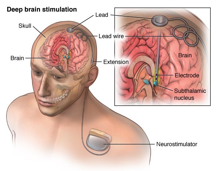 Brain Stimulation as Addiction Treatment: Science Fiction ...