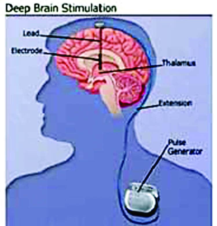 Deep brain stimulation: a light of hope for Parkinson