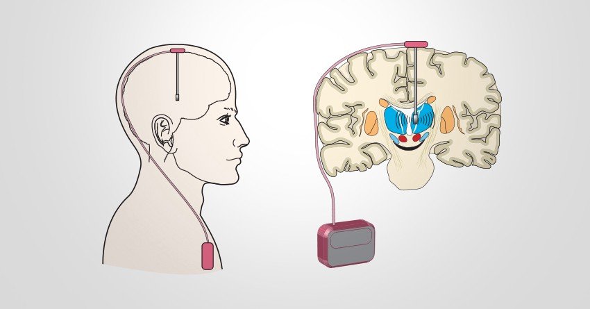 Deep brain stimulation for Parkinsonâs Disease and ...