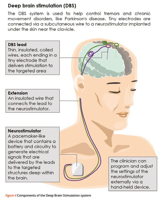Deep Brain Stimulation for Parkinsonâs Disease