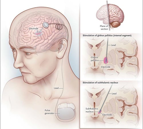 Deep Brain Stimulation Helpful in Some Patients With MS Tremor ...