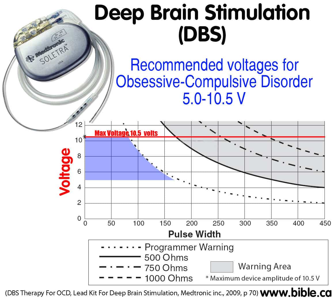 Deep brain stimulation(DBS): Mental Illness Obsessive