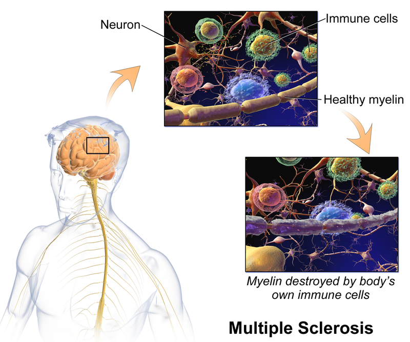 Difference Between Multiple Sclerosis and Systemic ...