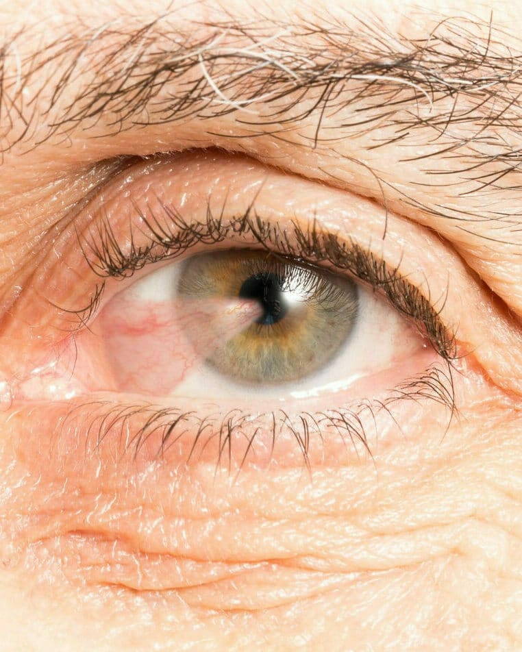 Does Parkinsons Disease Affect the Eyes?