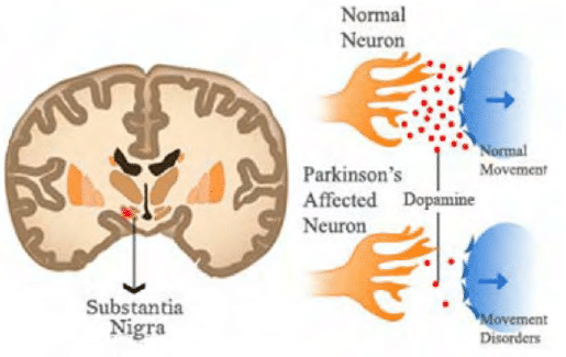Dopamine level in parkinson