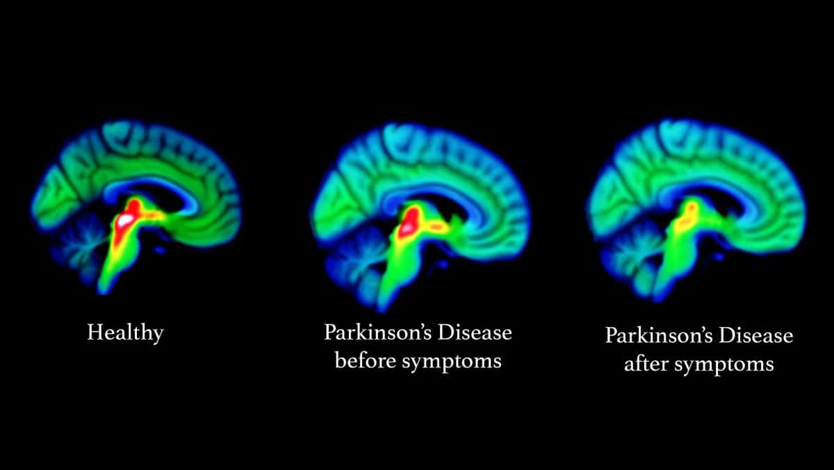 Early warning signal for Parkinson