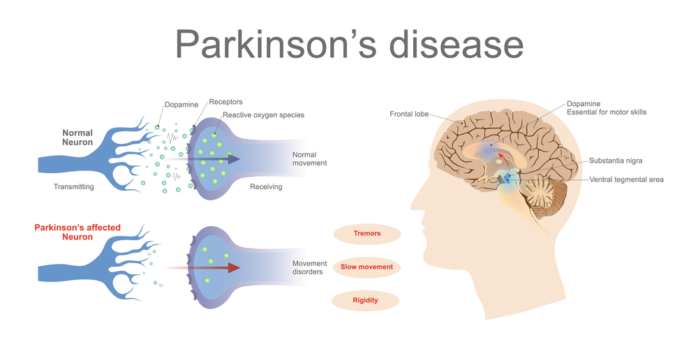 FAQS on Parkinson
