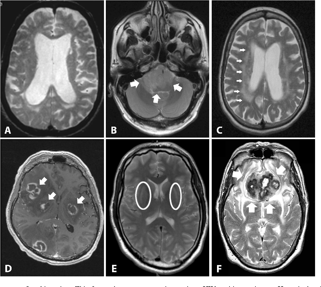 Can An Mri Diagnose Parkinson's - ParkinsonsInfoClub.com