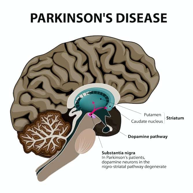 From blood letting to brain stimulation: 200 years of Parkinson