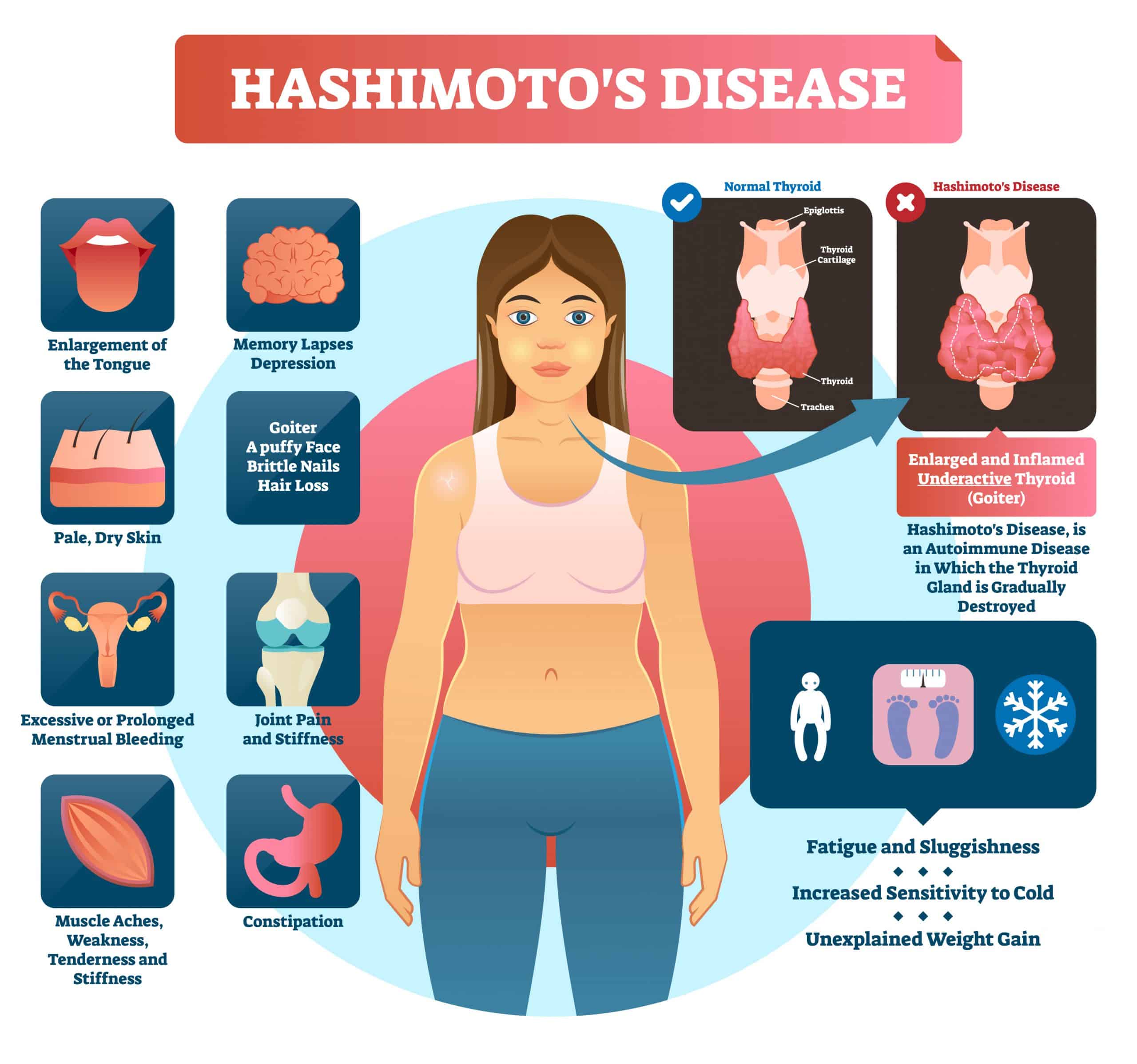 Help for Hashimotos DiseaseCauses, Complications, and Treatment
