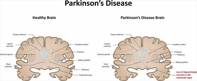 How does Parkinsonâs disease affect the body?