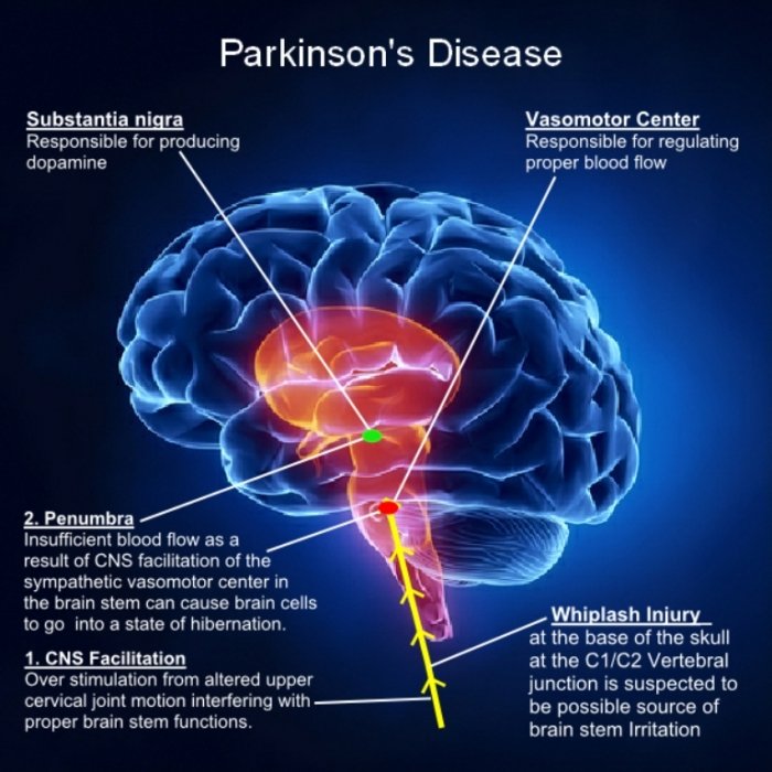 How Does Parkinson