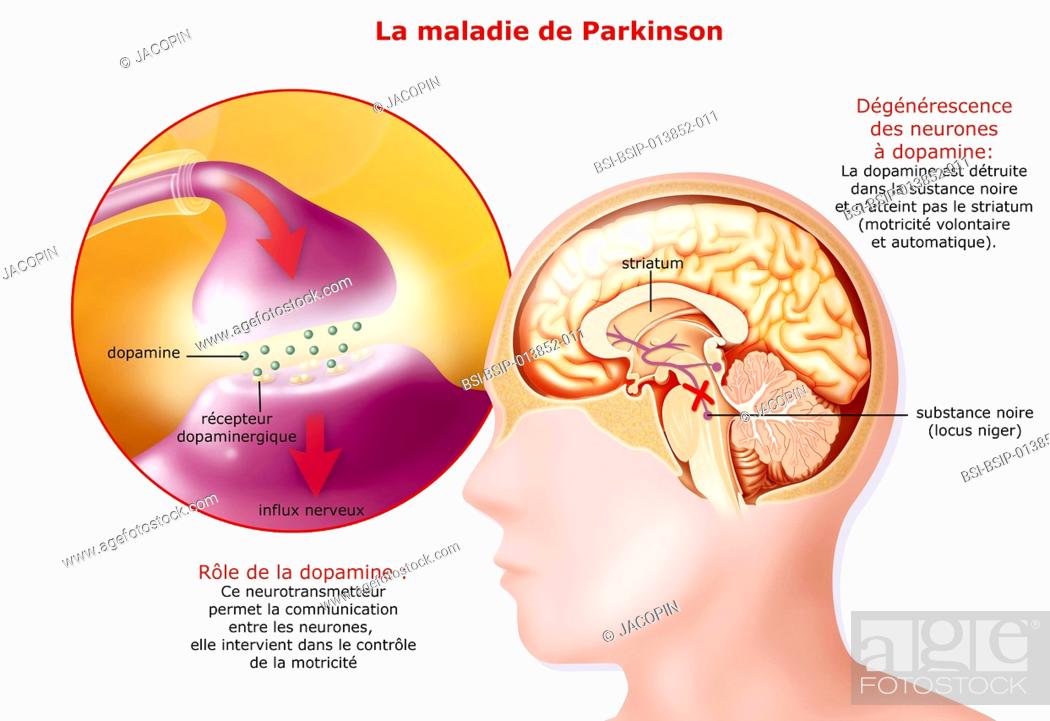 Illustration of Parkinsons disease. It affects dopamine ...