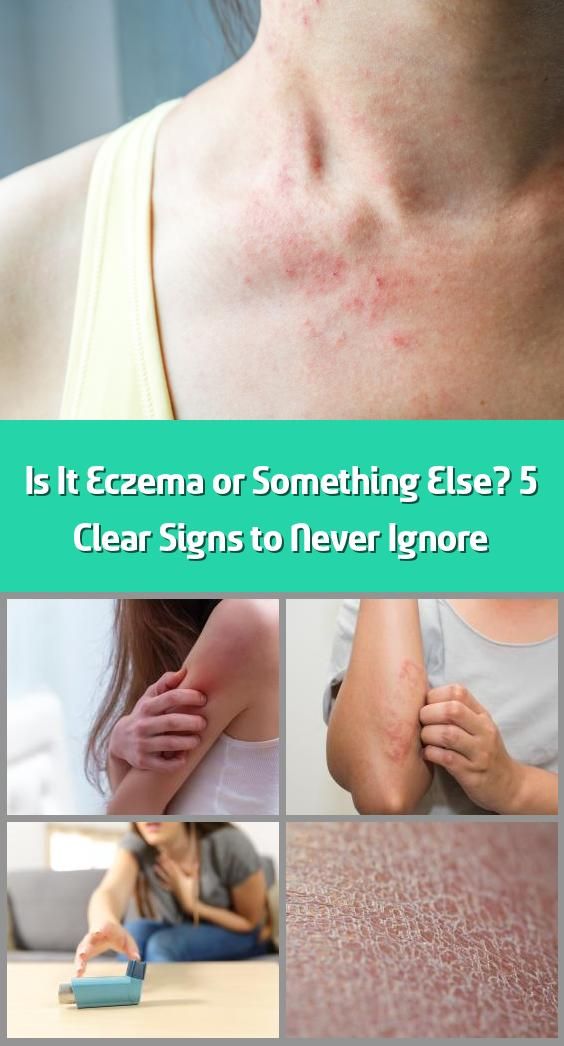 Is It Eczema or Something Else? 5 Clear Signs to Never ...