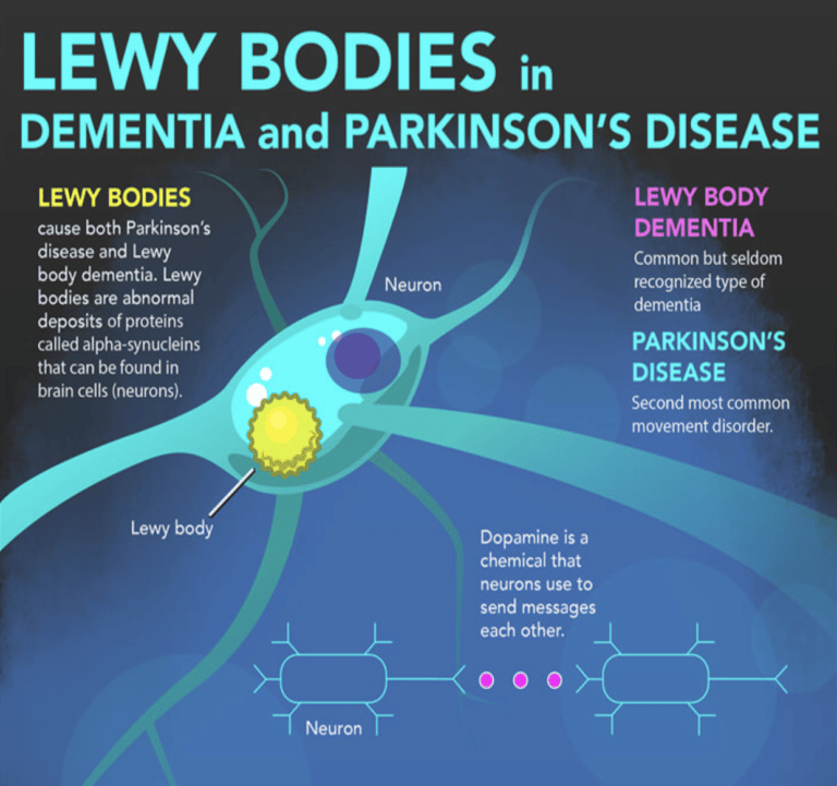 " Lewy Bodies in Dementia and Parkinson