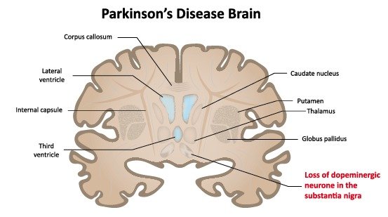 Living with Parkinson’s Disease