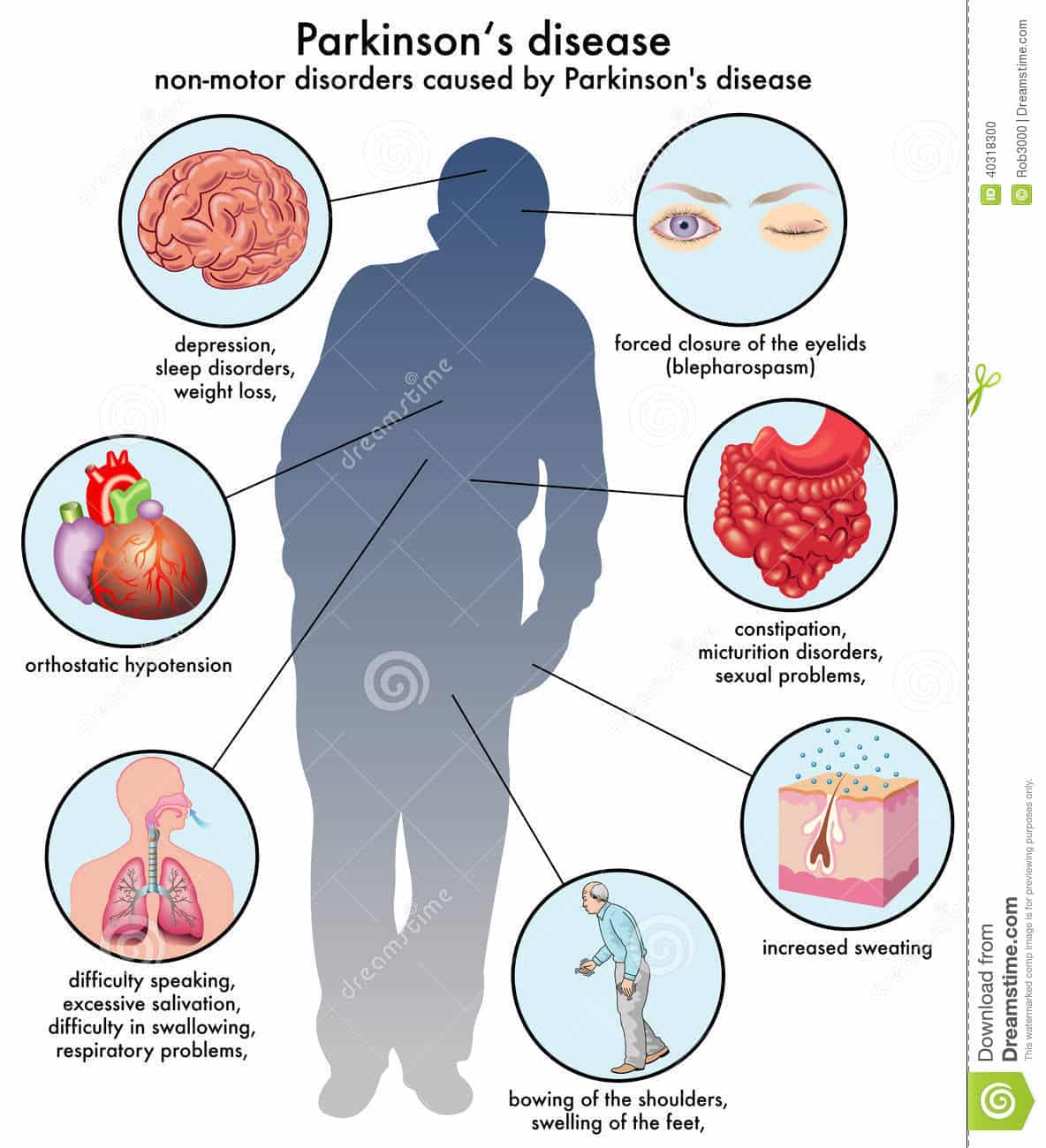 Malattia del Parkinson illustrazione vettoriale. Illustrazione di ...