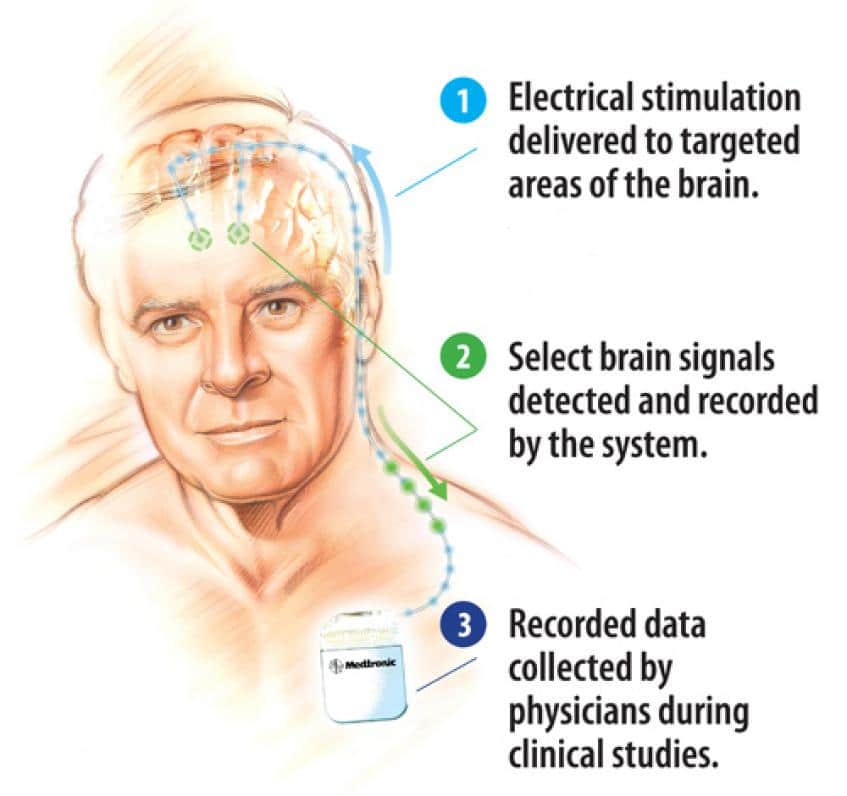 Medtronic Aims To Take Deep Brain Stimulation to New Level Through ...