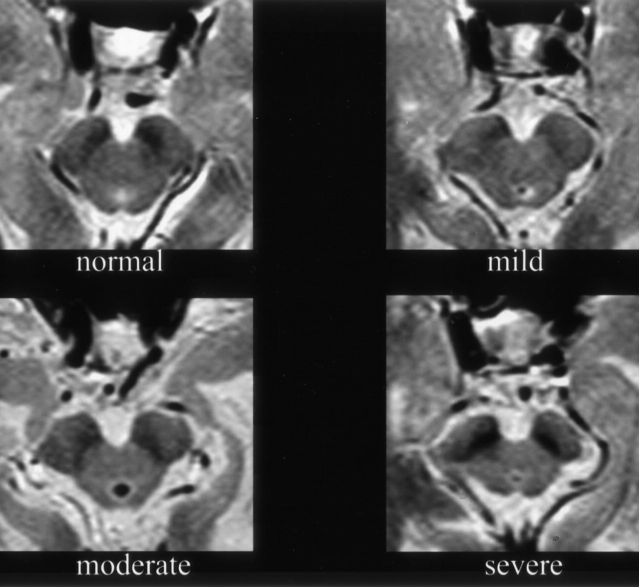 MR Imaging of the Superior Profile of the Midbrain: Differential ...