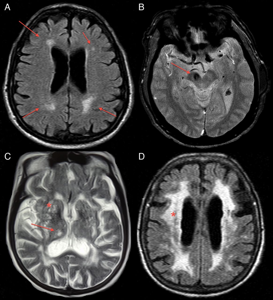 Mri Brain Scan Parkinsons Disease