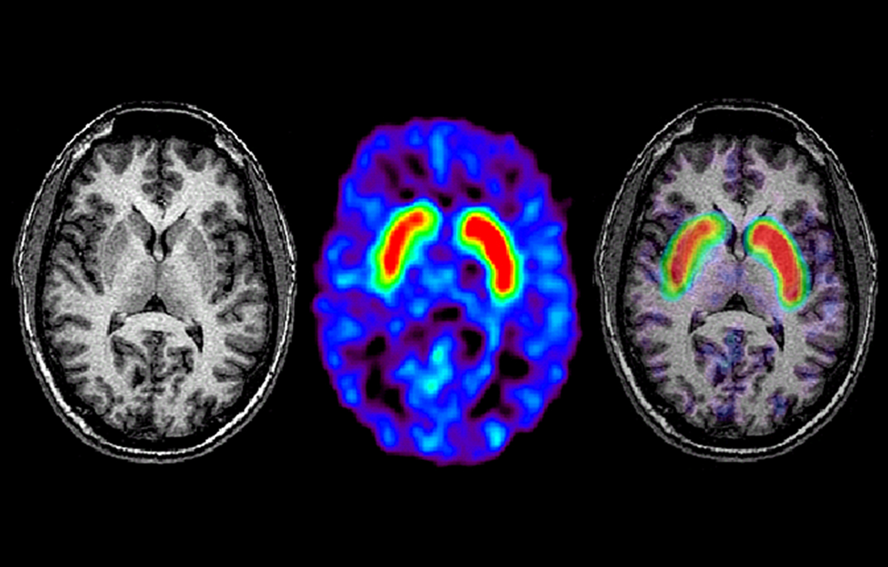 MRI in Parkinson Disease: Expanding Usability for Better ...