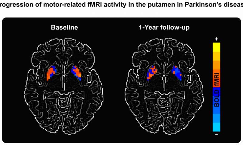 MRI Scans Showing Parkinson