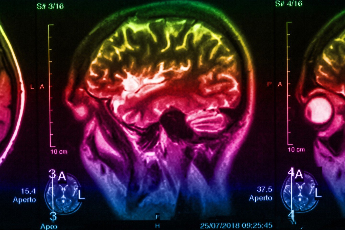 New brain imaging study reveals signs of Parkinsonâ€™s ...