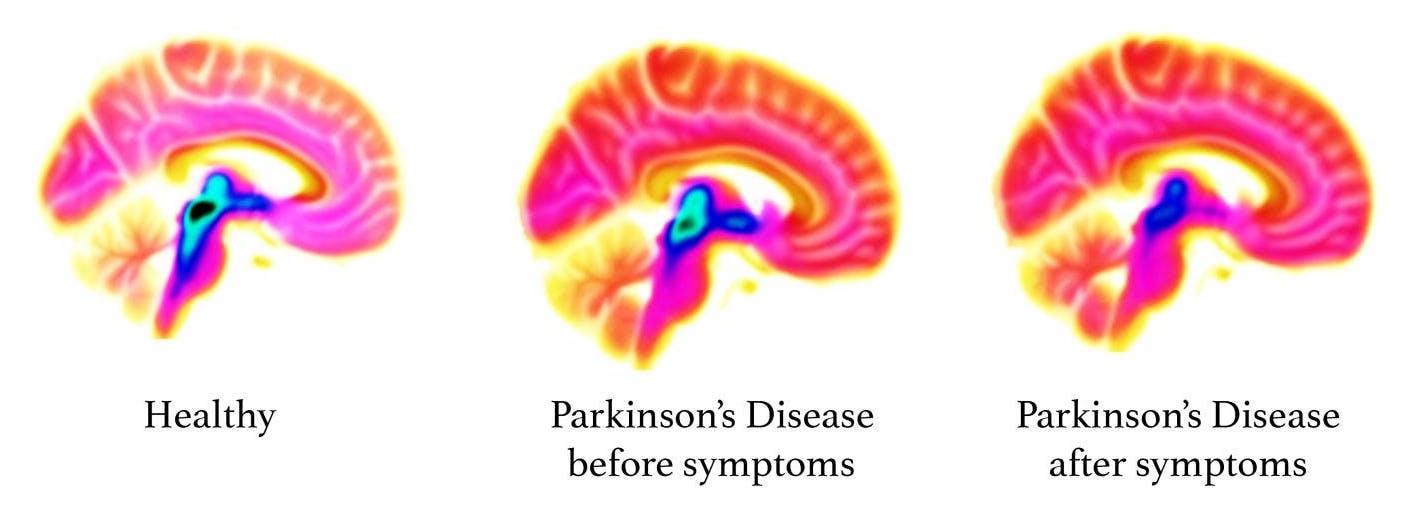 New brain imaging study reveals signs of Parkinsons decades before ...