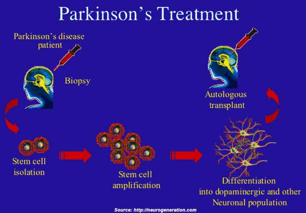 Parkinsonâs Disease: Types, Symptoms, Causes, Diagnosis ...