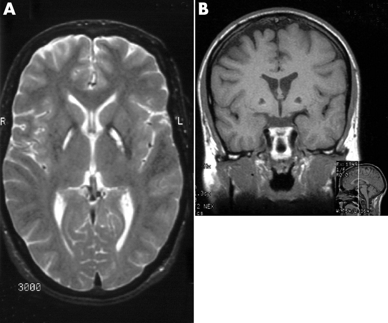 Parkinsonism following bilateral lesions of the globus ...