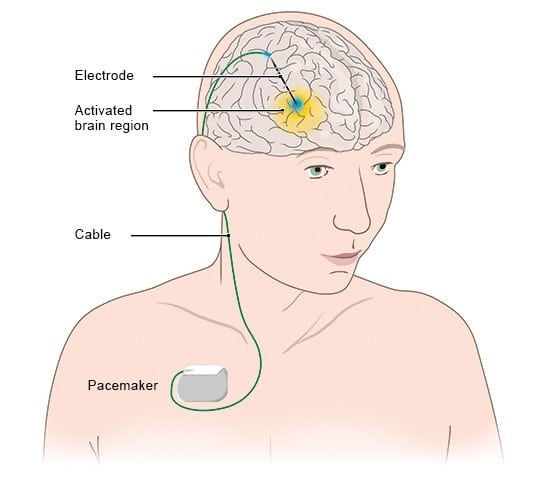 Parkinsons disease: Deep brain stimulation