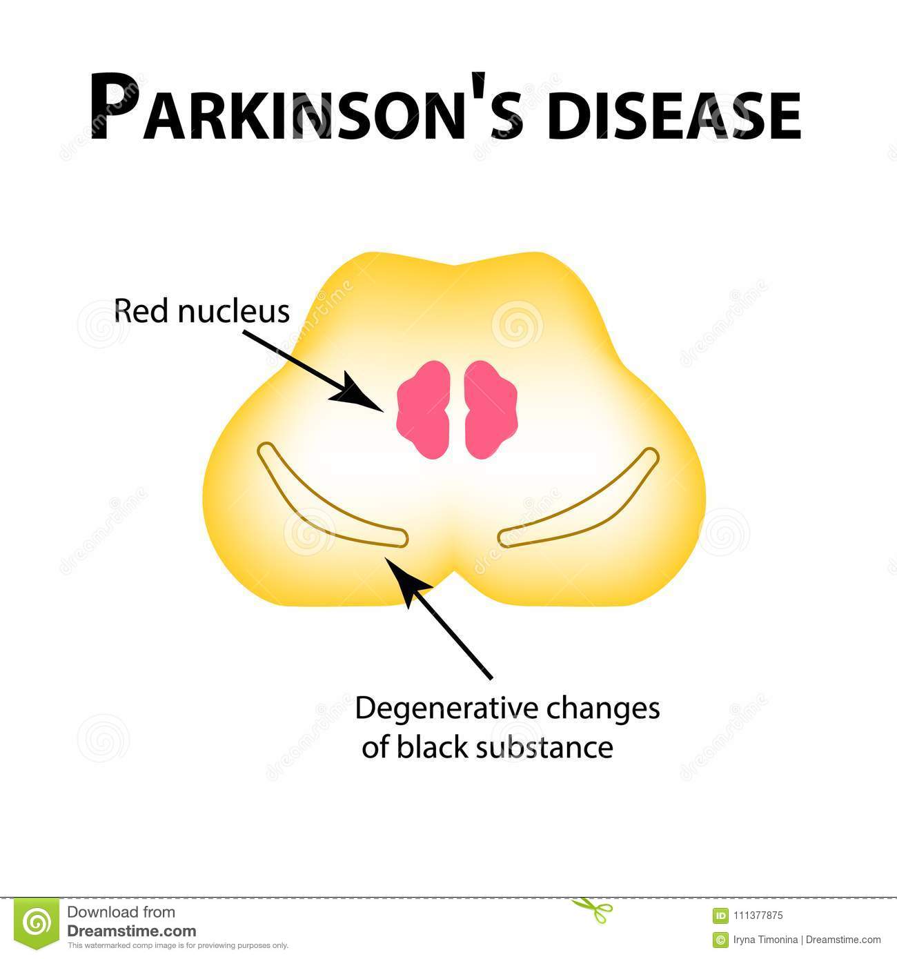Parkinson`s Disease. Degenerative Changes In The Brain Are A Black ...