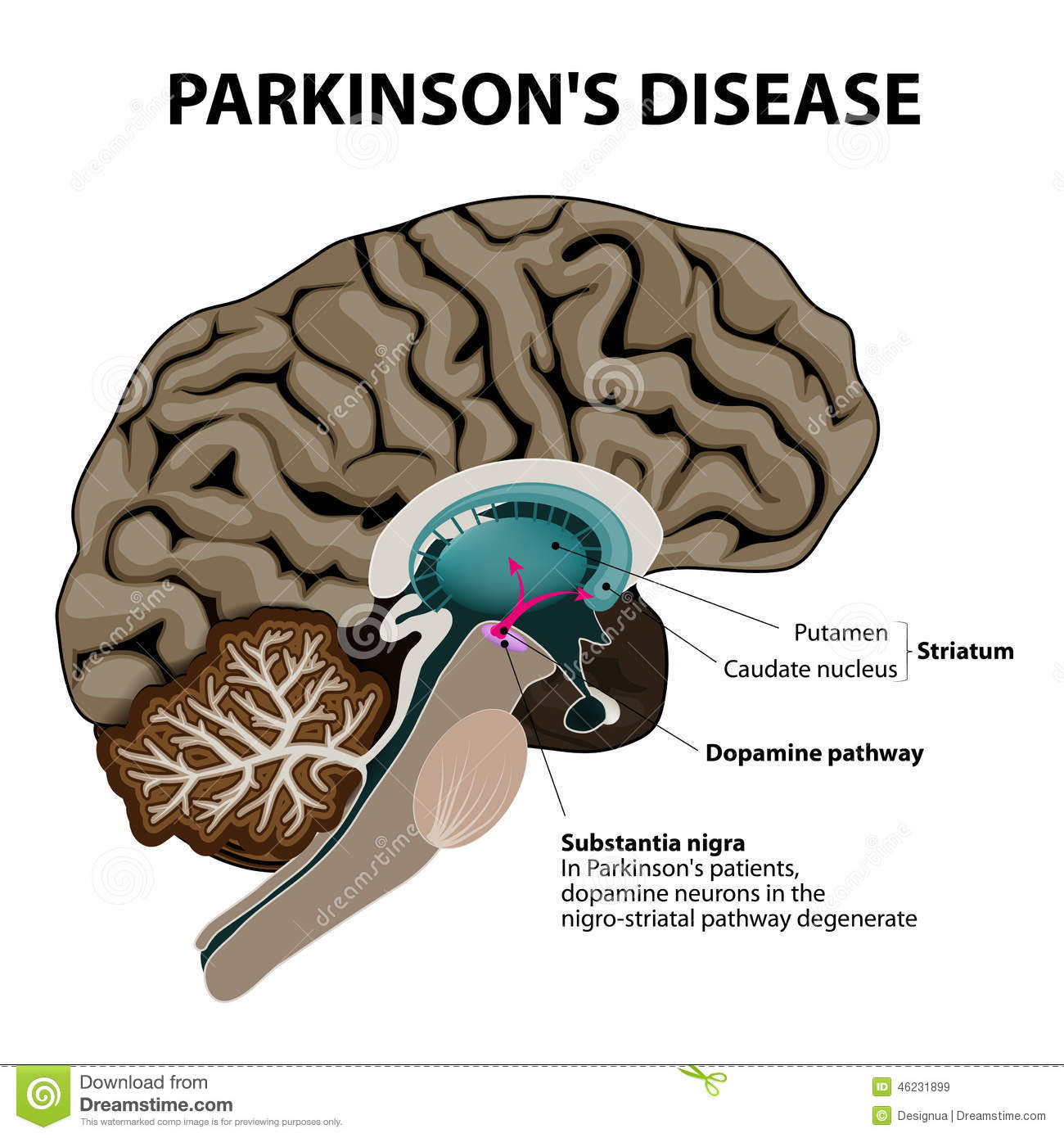 Parkinsons Disease stock vector. Illustration of ...