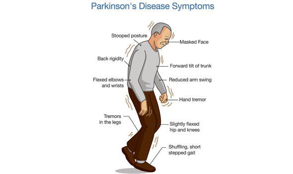 Parkinson’s disease symptoms: Oily skin could be a sign of ...