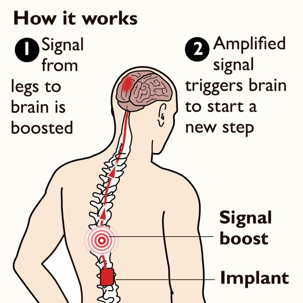 Parkinsons implant helps patients walk safely again