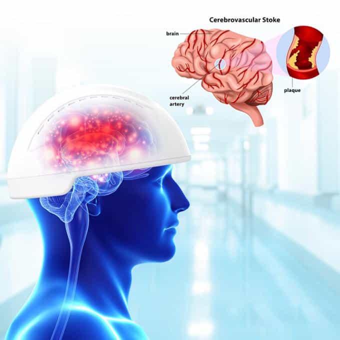 Photobiomodulation Helmet Treatments for Parkinsonâs Alzheimerâs Disease