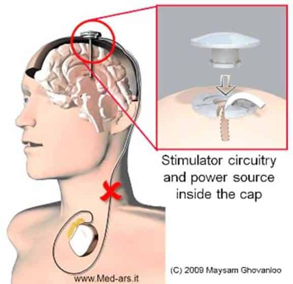 Pin on Deep Brain Stimulation (DBS)