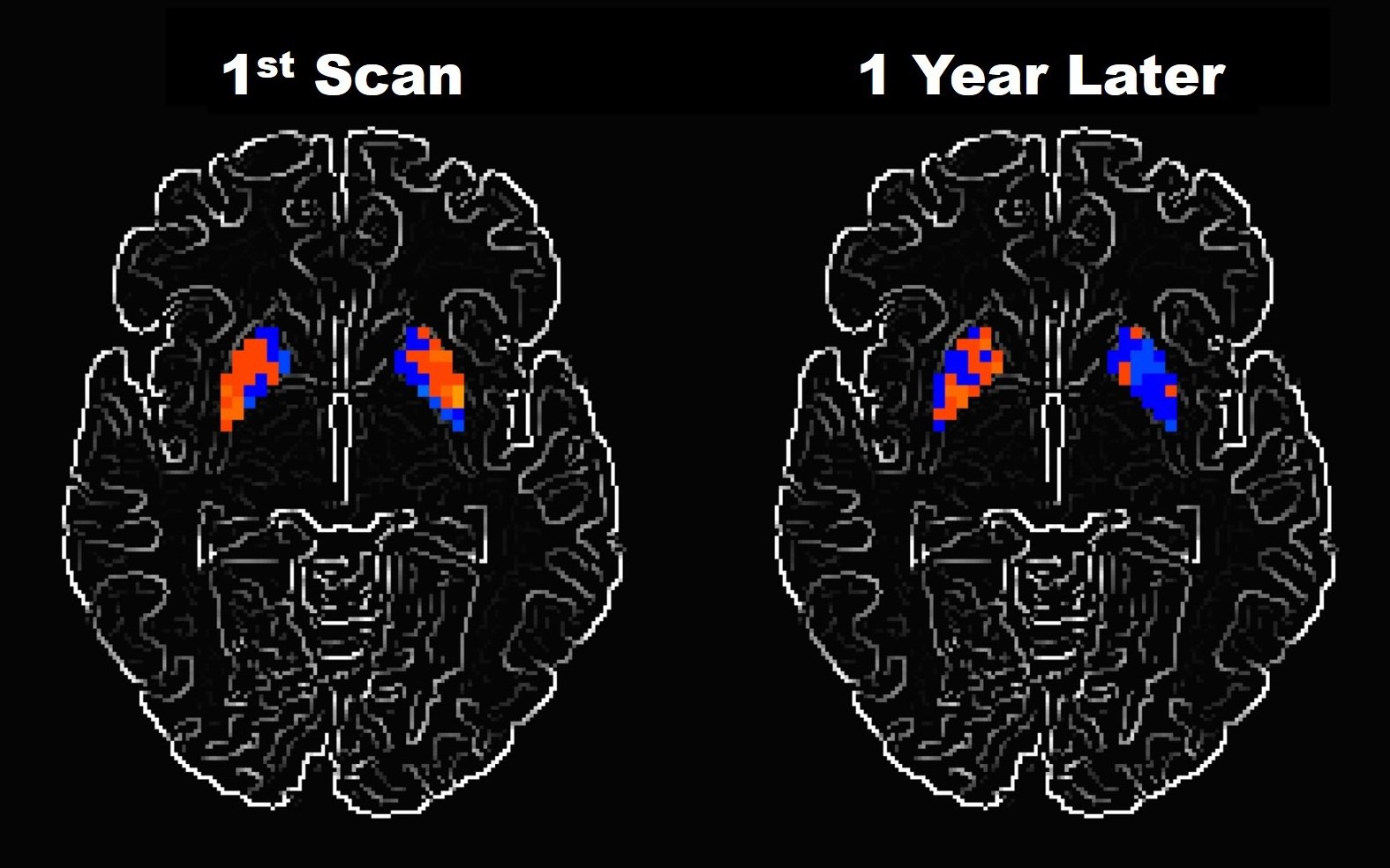 Researchers examine how Parkinsonâs disease alters brain ...