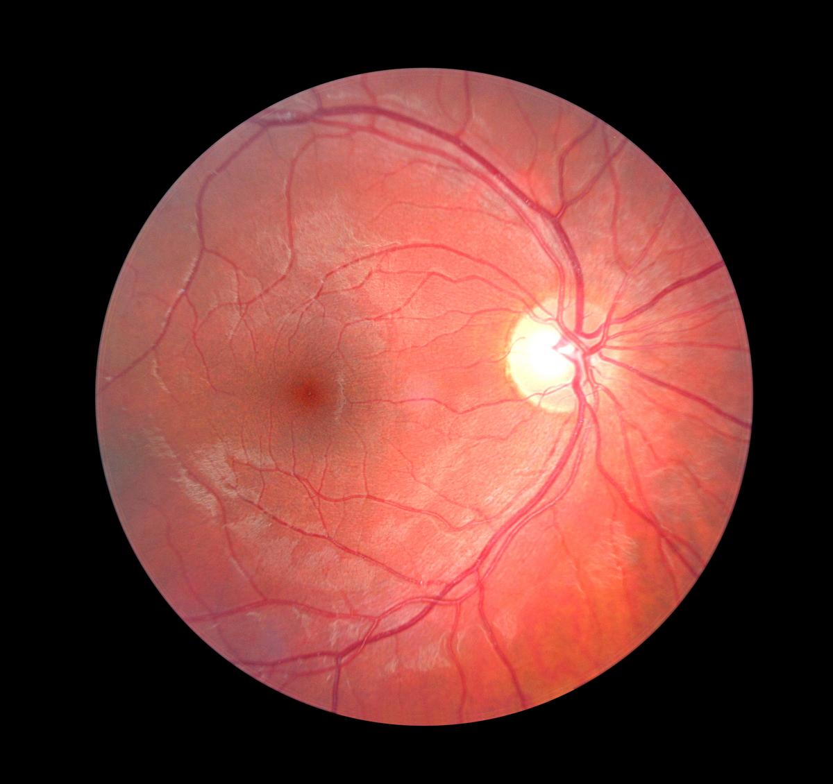 Retinal thinning could provide early sign of Parkinson